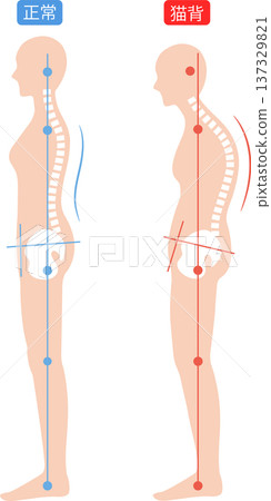 女性的駝背和正確姿勢：脊椎和骨盆 137329821