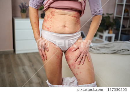 Woman showing red skin rash from allergy or illness Woman showing red skin rash from allergy or illness 137330203