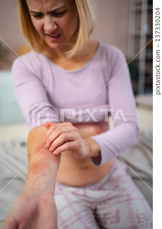 Woman scratching itchy arm with skin rash due to allergy Woman scratching itchy arm with skin rash due to allergy 137330204
