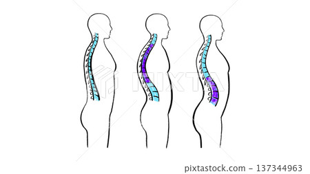 Scoliosis spine deformity Scoliosis spine deformity 137344963