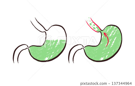 Gastroesophageal reflux pain 137344964