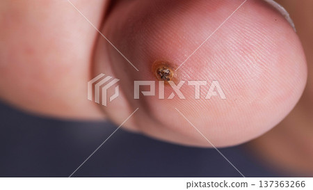 Plantar Wart In High Detail. A Close-Up Shot Illuminates The Viral Infection On The Skin. Plantar Wart In High Detail. A Close-Up Shot Illuminates The Viral Infection On The Skin. 137363266
