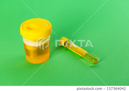 A test tube with reagent and urine on a green background. Bacterial culture for Enterobacteriaceae and Staphylococcus saprophyticus bacteria, which cause pain and inflammation in the urinary tract. A test tube with reagent and urine on a green background. Bacterial culture for Enterobacteriaceae and Staphylococcus saprophyticus bacteria, which cause pain and inflammation in the urinary tract. 137364042