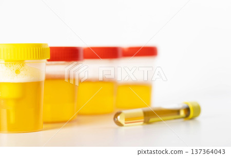 Various urine containers and a urine culture tube. Urine analysis concept with sediment microscopy, which reveals the condition of the kidneys and urinary tract, close-up Various urine containers and a urine culture tube. Urine analysis concept with sediment microscopy, which reveals the condition of the kidneys and urinary tract, close-up 137364043