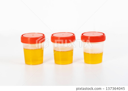 A three-glass urine sample on a white background for testing urinary tract pathogens. Chlamydia and Trichomonas, gonococcus, close-up 137364045
