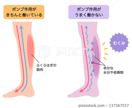 腿部腫脹：水腫的成因 137367557