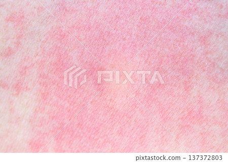 Skin allergy rash dermatitis texture close up Skin allergy rash dermatitis texture close up 137372803