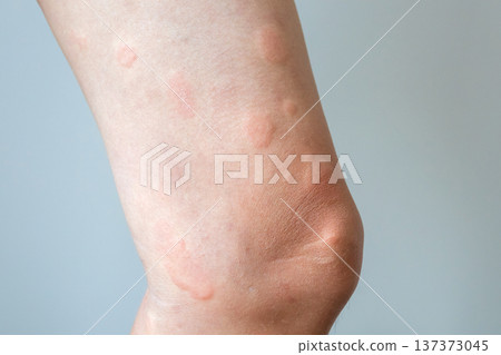Young asian man has allergic skin rash on his legs from itchy dry skin eczema dermatitis insect bites 137373045