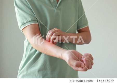 Young asian man itching and scratching on arm from allergic itchy dry skin eczema dermatitis insect bites Young asian man itching and scratching on arm from allergic itchy dry skin eczema dermatitis insect bites 137373072