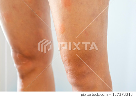 Young asian man has allergic skin rash on his legs from itchy dry skin eczema dermatitis insect bites 137373313