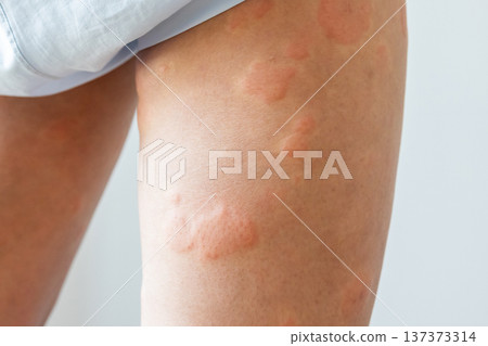 Young asian man has allergic skin rash on his legs from itchy dry skin eczema dermatitis insect bites Young asian man has allergic skin rash on his legs from itchy dry skin eczema dermatitis insect bites 137373314
