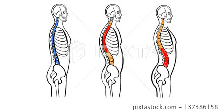 Scoliosis spine deformity Scoliosis spine deformity 137386158