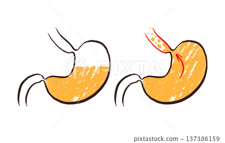 Gastroesophageal reflux pain 137386159