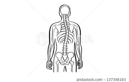 Scoliosis spine deformity 137386163