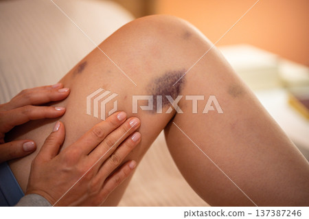 Leg bruise, capillary rupture after bump. Woman checking leg at home, squeezing damaged skin Leg bruise, capillary rupture after bump. Woman checking leg at home, squeezing damaged skin 137387246