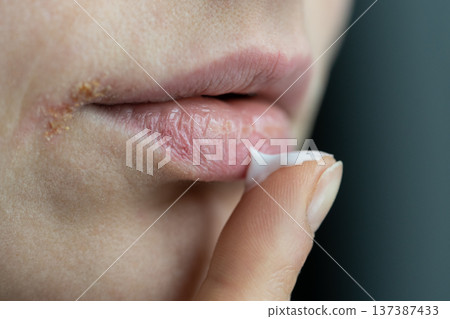 Closeup of woman applying lip balm with finger to prevent dryness and chapping in cold season Closeup of woman applying lip balm with finger to prevent dryness and chapping in cold season 137387433