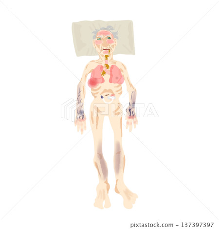 Elderly patient with pneumonia - Illustration of the overall condition of a bedridden patient Elderly patient with pneumonia - Illustration of the overall condition of a bedridden patient 137397397