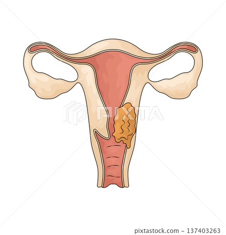 Illustration of Cervical Cancer Illustration of Cervical Cancer 137403263