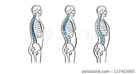 Scoliosis spine deformity Scoliosis spine deformity 137423083