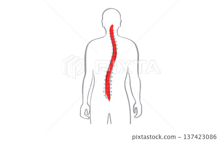 Scoliosis spine deformity Scoliosis spine deformity 137423086