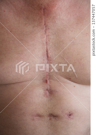 scar on a man's chest after heart surgery 137447057
