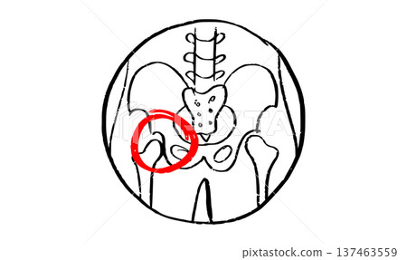 Osteomyelitis disease sketch Osteomyelitis disease sketch 137463559