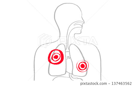 Lung disease concept 137463562