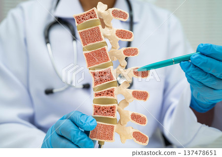 Doctor holding osteoporosis in back bone model for treatment medical. 137478651