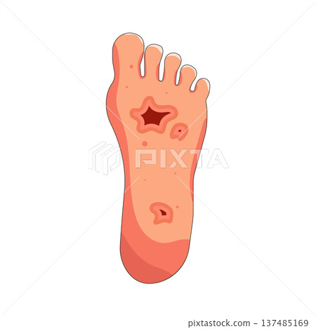 Illustration of Diabetic foot Illustration of Diabetic foot 137485169