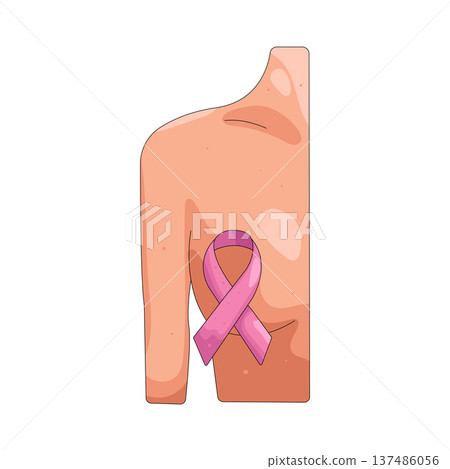 Illustration of Breast cancer 137486056