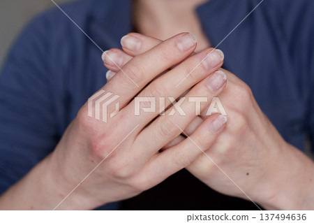 Damaged natural nails after gel polish removal on female hands 137494636