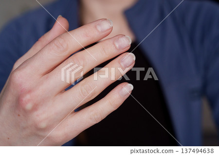 Close up of damaged fingernails after gel polish removal 137494638