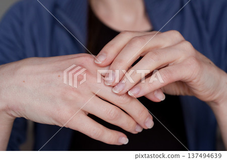 Damaged natural nails after gel polish removal on female hands 137494639