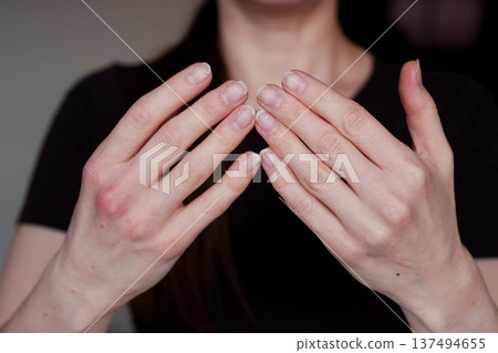 Female hands with weak natural nails and damaged manicure 137494655