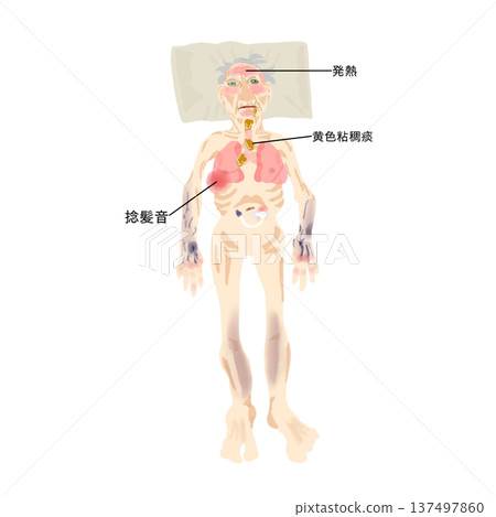 肺炎全身表現圖解 | 一目了然地展現臥床老年病患病情的醫學圖示 肺炎全身表現圖解 | 一目了然地展現臥床老年病患病情的醫學圖示 137497860