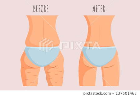 Girl with and without cellulite. Fat slim female butt, legs and back. Body before and after fitness training, diet, healthy nutrition results, sapid vector concept 137501465
