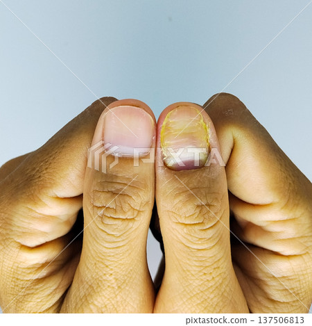 Close up of a nail fungus on a white background Close up of a nail fungus on a white background 137506813