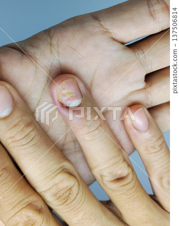 swollen and pus-filled hands due to ingrown toenails swollen and pus-filled hands due to ingrown toenails 137506814