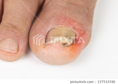 Ingrown toenail on a senior feet with white backgroundClose-up ingrown toenail on senior feet with white background. Ingrown toenail on a senior feet with white backgroundClose-up ingrown toenail on senior feet with white background. 137532590