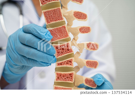 Doctor holding osteoporosis in back bone model for treatment medical. Doctor holding osteoporosis in back bone model for treatment medical. 137534114