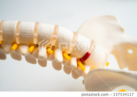 Spinal nerve and bone, Lumbar spine displaced herniated disc fragment, Model for treatment medical in the orthopedic department. 137534117
