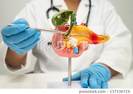 Pancreatitis, pancreatic cancer, Asian doctor with pancreas, gallbladder and bile duct human model. 137536729