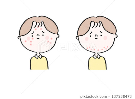 Men suffering from adolescent acne and men suffering from adult acne (comparison of acne areas) 137538473