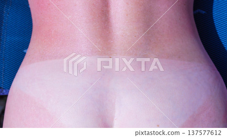 Woman body after taking off bikini with visible tan line from wearing panties Woman body after taking off bikini with visible tan line from wearing panties 137577612