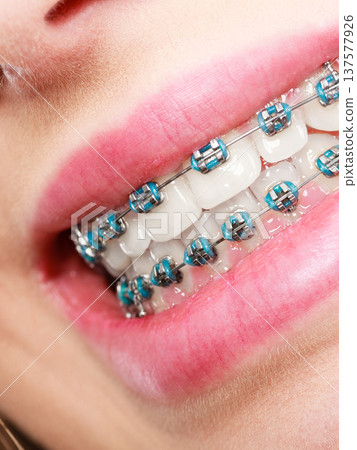 Woman showing her teeth with braces 137577926