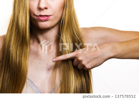 Woman with skin problem acne on neckline Woman with skin problem acne on neckline 137578552