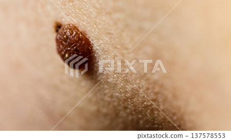 Closeup brown mole on skin. 137578553