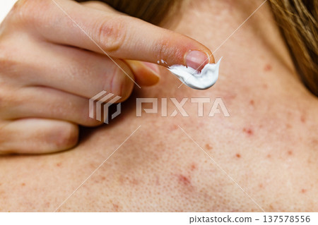 Woman with pimple on back applying medical ointmeny 137578556