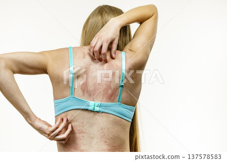 Woman scratching her itchy back with allergy rash Woman scratching her itchy back with allergy rash 137578583