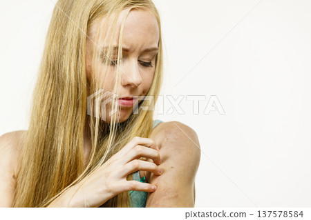 Woman scratching her itchy arm. Skin allergy. 137578584